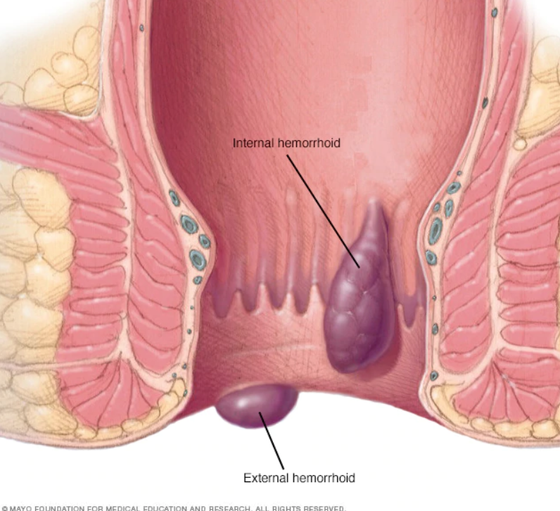 Top 3 tips for hemorrhoids & anal fissures
